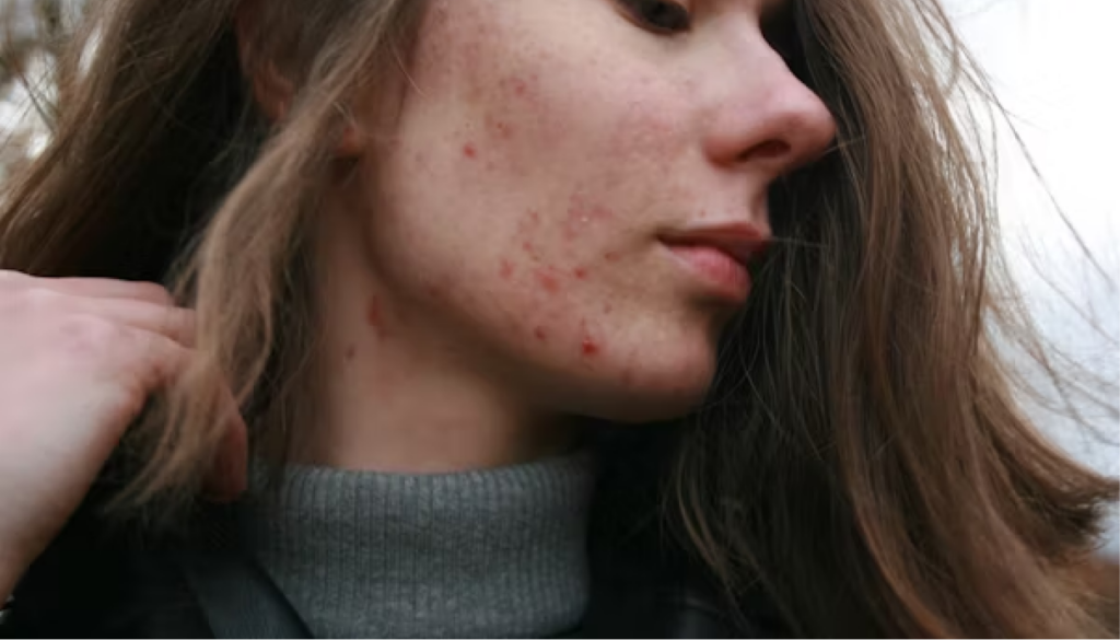 ニキビが気になる人に