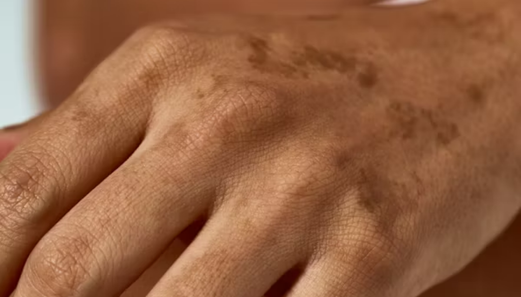 混合肌におすすめ